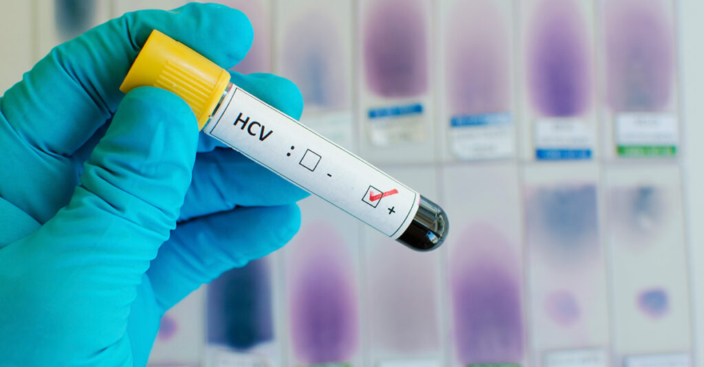 Hepatit C