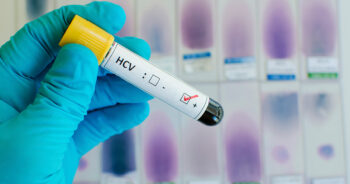 Hepatit C
