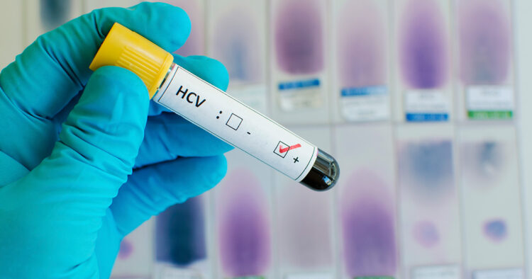 Hepatit C